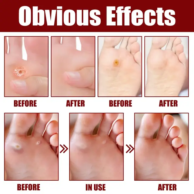foot corn removal foot corn removal