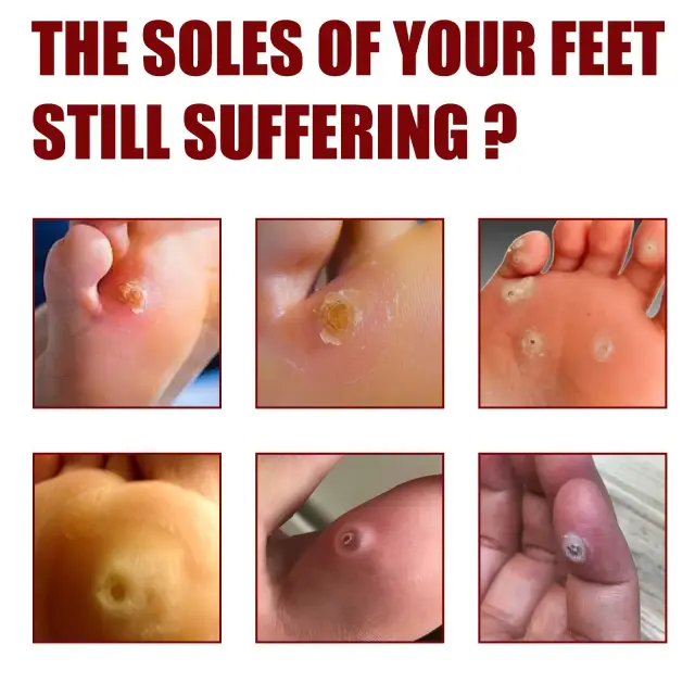 foot corn removal foot corn removal